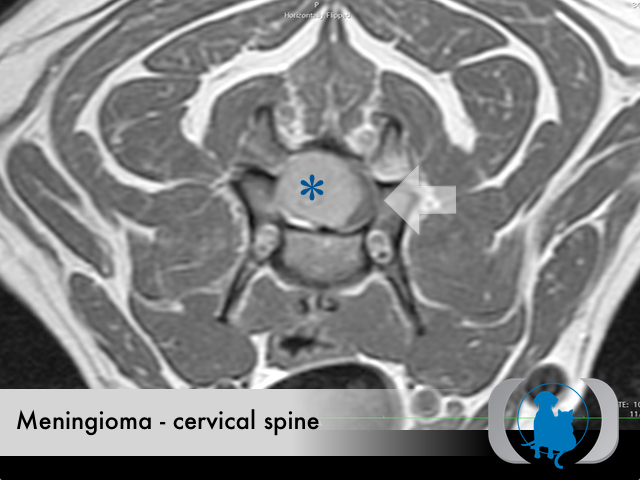 Meningioma spinal