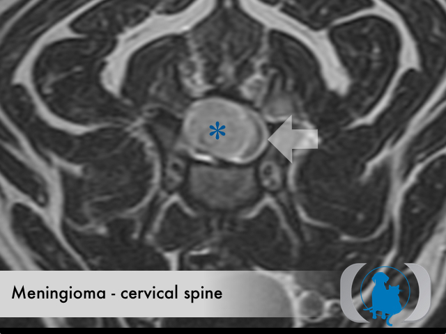 Meningioma spinal