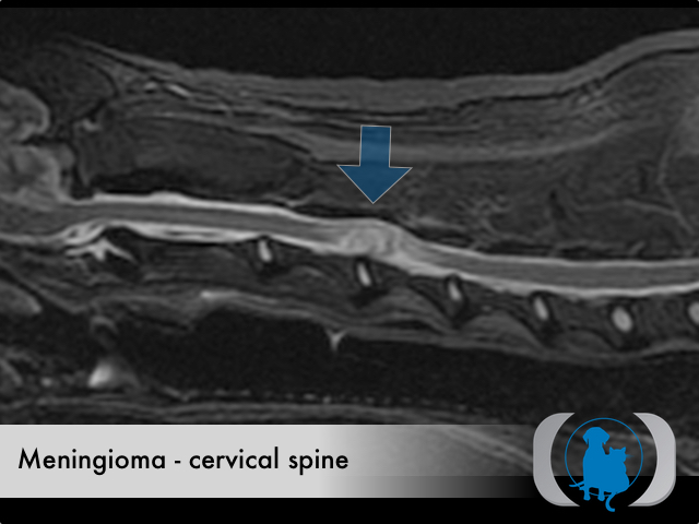 Meningioma spinal