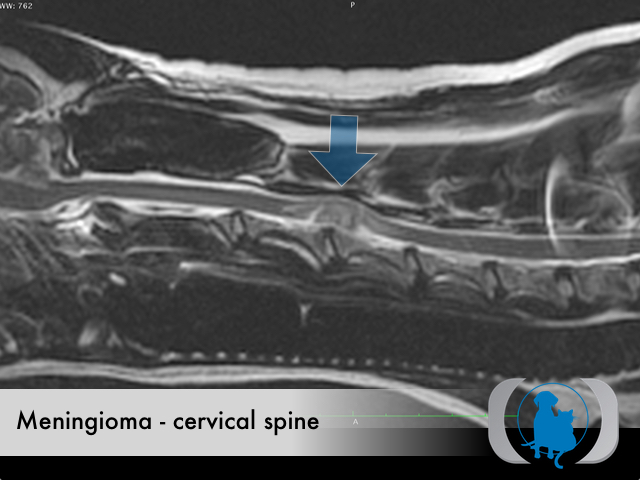 Meningioma spinal