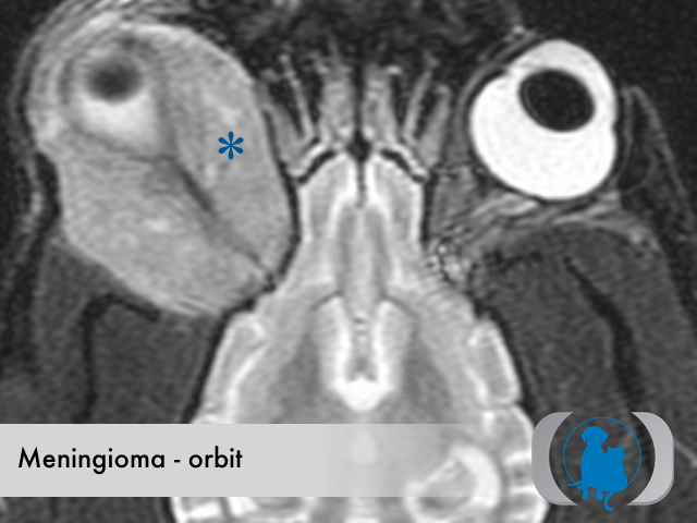 Meningioma orbital