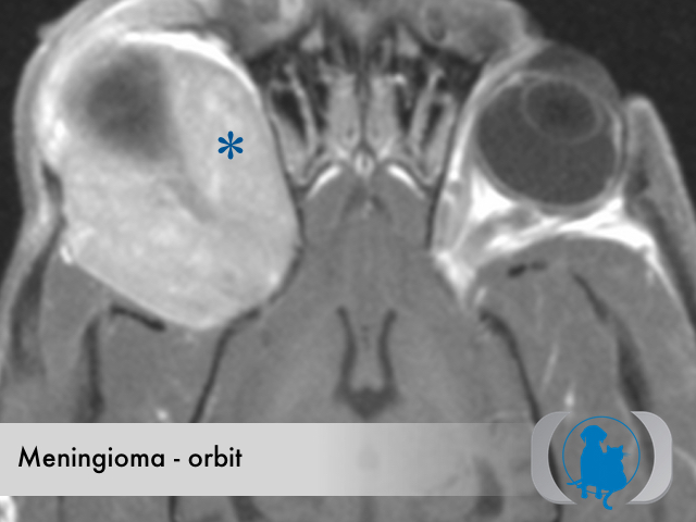 Meningioma orbital