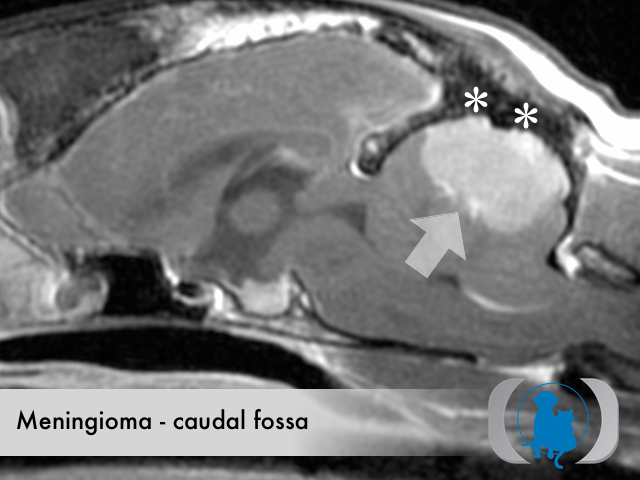 Meningioma caudal fossa