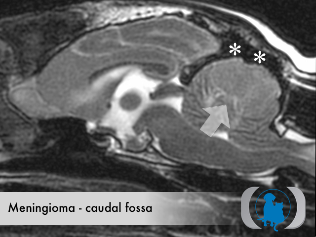 Meningioma caudal fossa