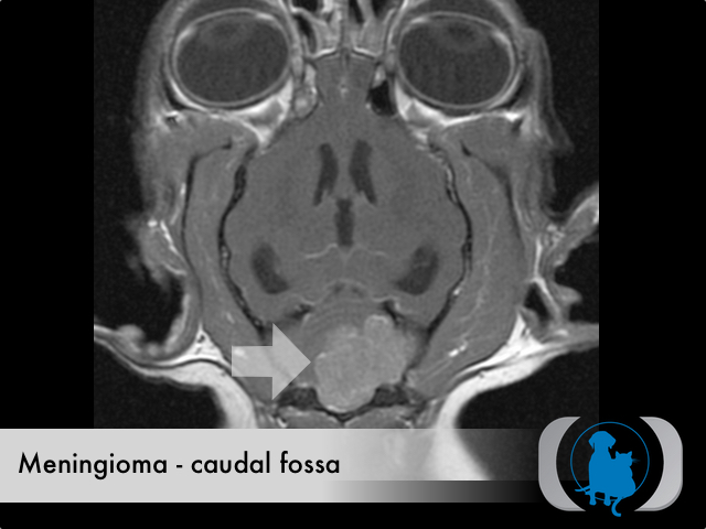 Meningioma caudal fossa