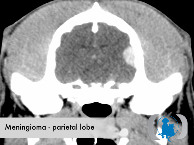 Meningioma caudal fossa