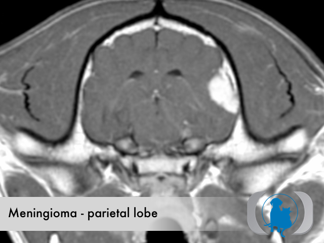 Meningioma caudal fossa